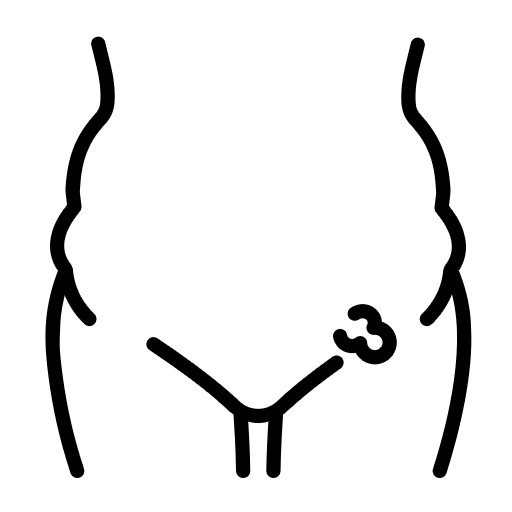 inguinal-herniav2